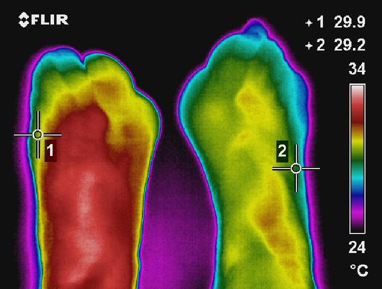 Thermography Feet